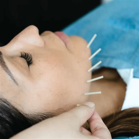 facial acupuncture traditional chinese medicine acupuncture