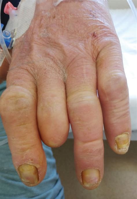 Yellow Discoloration On My Nails at Adam Curtis blog