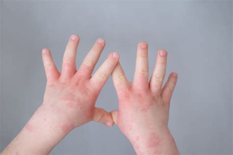 eczema  symptoms treatment options