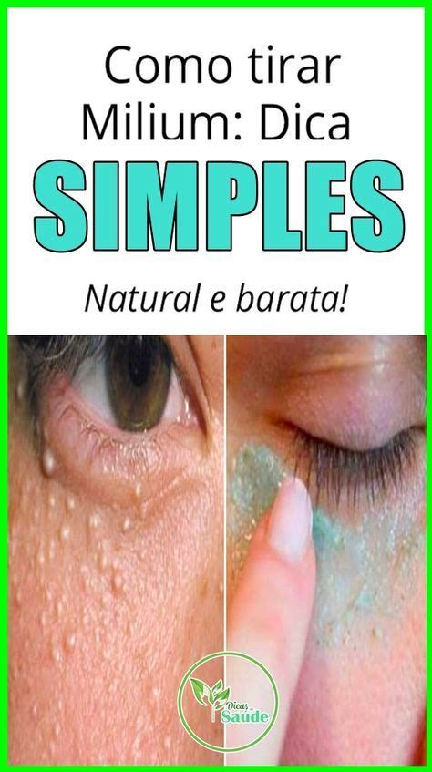 Milium Sebáceo Como Tirar - Como Tirar Milium Do Rosto Em Casa – Seguro, Fácil E Sem | Remédio para ...