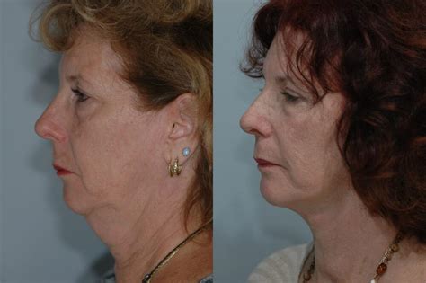 Mini Facelift | Long Island, NY | Dr. Marotta