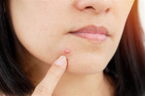 powerful home remedies  pimples easy effective remedies
