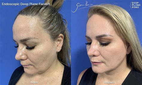 endoscopic facelift india  david oldham blog