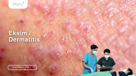 konsultasi eksim dermatitis