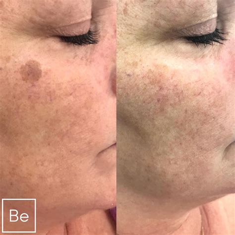 Sun Spot and Age Spot Removal in Rochester, NY | Bare Element