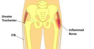 Greater Trochanteric Pain Syndrome (GTPS) - My Family Physio