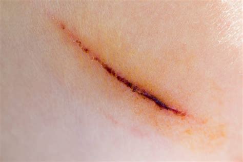 Knee Surgery Scars Stock Photos, Pictures & Royalty-Free Images - iStock