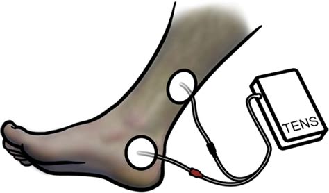 invasive transcutaneous electrical stimulation   treatment