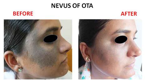 nevus  ota amrit clinic