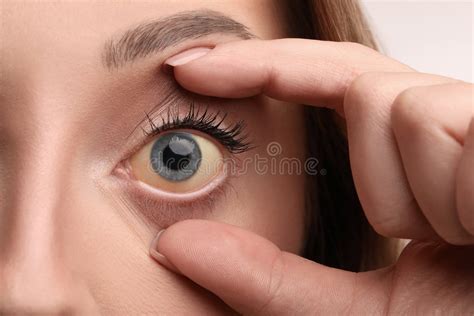 201 Yellow Liver Eyes Stock Photos - Free & Royalty-Free Stock Photos ...