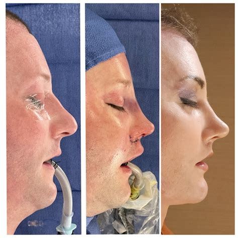 14 Facial Procedures in 7 months (Plastic Surgery Saved My Life) : r