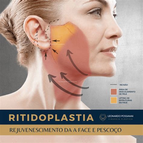 Ritidoplastia O Que É - Ritidoplastia – Leonardo Possamai