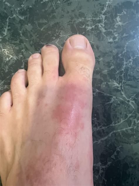 Problem with feet - anyone who had similar symptoms? : r/CaminoDeSantiago