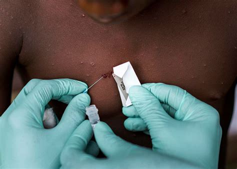 Philippines Reports First Case Of Mpox In 2024