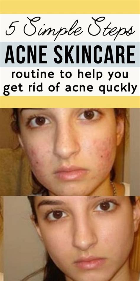 Simple Skin Care Routine for Acne — Get Rid Of Acne only in 5 Steps