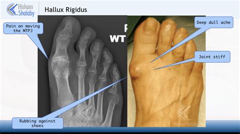 Hallux Rigidus – Mr Hisham Shalaby