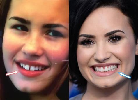 Did Demi Lovato Have Cosmetic Surgery? (Before & After 2018!)