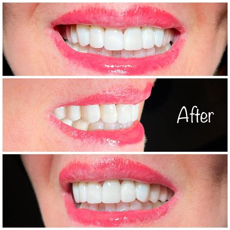 Best Teeth Whitening Procedures near Spring 77379- Dental professionals