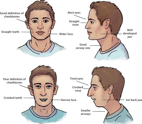 Mouth Breathing | Anita Carmen Choy MD