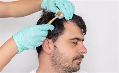Can Microneedling Help Your Scalp Regrow Hair? – diaminyaesthetics