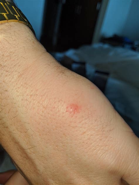 Recurring Itchy Bumps : r/Dermatology