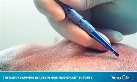 sapphire blades  hair transplant surgery
