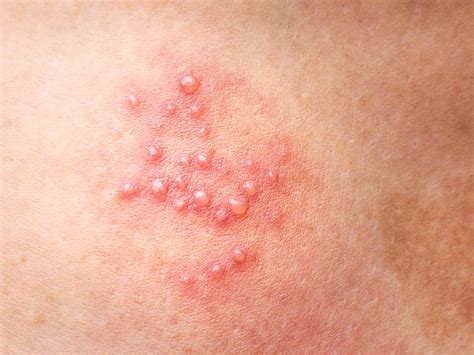 Shingles and Encephalitis: Symptoms, Causes, and Treatment