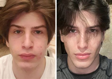 bone smashing  chin extensions  looksmaxxing