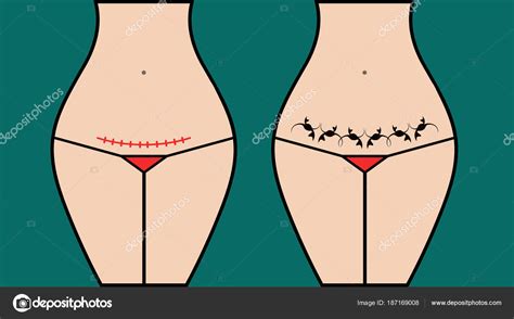 Masking cesarea scar section tattoo Stock Vector by ©tomozina1.yandex ...