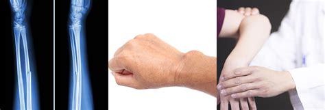 hand wrist elbow advanced physicians  sports orthopedic medicine