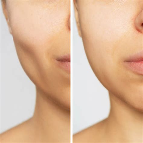 Juvéderm Voluma XC Cheek Fillers in Santa Rosa and Healdsburg