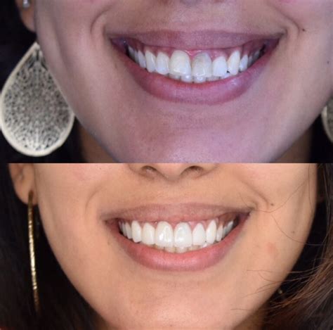 Before and After Veneers Procedure | Dr. Christian Chung, D.D.S.