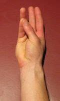 Sprained Thumb - Thumb Sprain - PhysioAdvisor