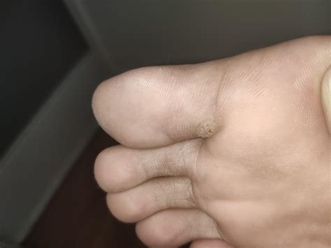 Painful bump on foot? (20M) : r/DiagnoseMe