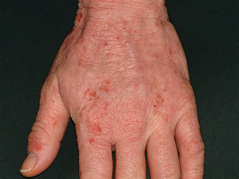atopic dermatitis  hands