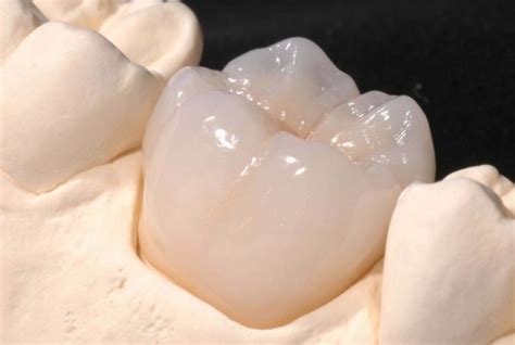 Cerec Crown | Sydney CBD Dentistry