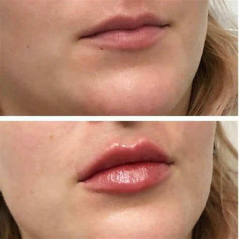 1 Ml De Ácido Hialurônico Na Boca Antes E Depois - Arquivos preenchimento com acido Hialurônico nos labios - Clínica Fit ...