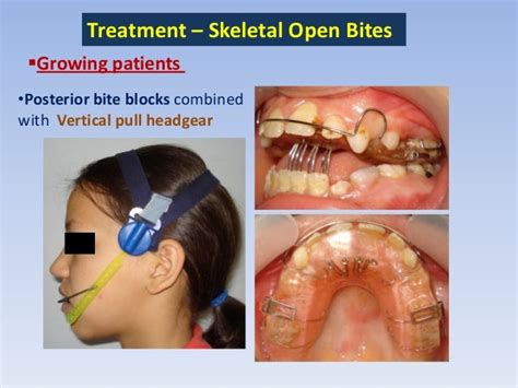 Anterior open bite treatment deciduous and mixed dentition .slide