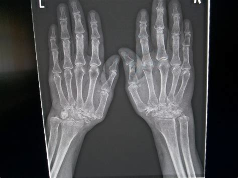 Rheumatologe: Rheumatoid Arthritis - Radiographic Progression