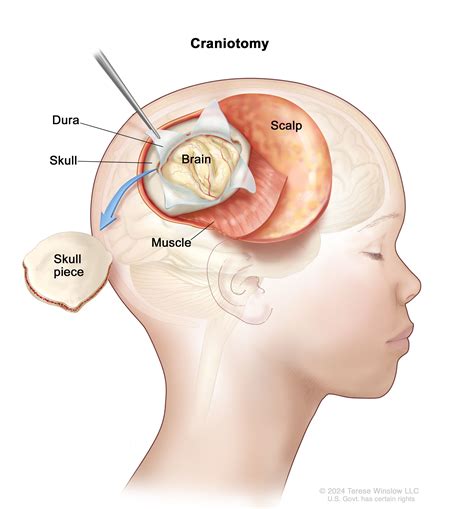 Childhood diffuse intrinsic pontine glioma (DIPG) - NCI