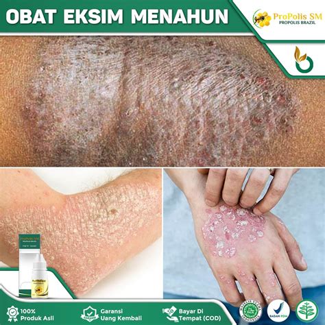 obat eksim menahun eksim kering eksim basah salep eksim gatal kulit
