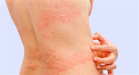 Alergia Na Pele Que Coça E Fica Vermelho E Inchado - 8 causas de manchas vermelhas na pele que coçam