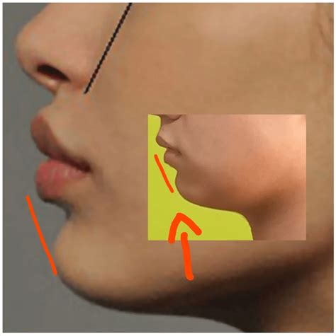 Reverse pull headgear : r/orthotropics