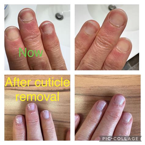 Cuticle Remover Before And After