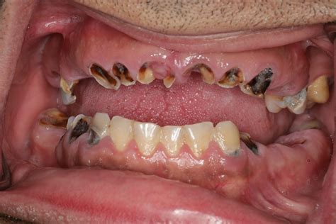 Fix Worn Teeth with All-on-4/6 Dental Implants - Burbank, CA