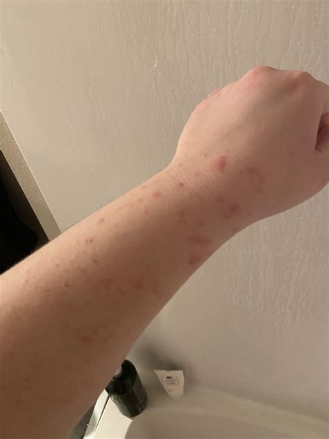 Identifying The Lamictal Rash: Visual Guides And Vital Warning Signs 13