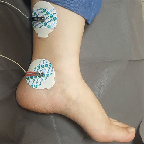 (PDF) The Effect of Transcutaneous Posterior Tibial Nerve Stimulation ...