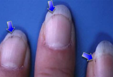 Veränderungen der Fingernägel: 15 Schlüssel zur richtigen Diagnose