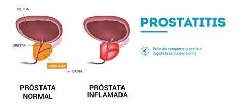 Como Saber Se A Prostata Esta Inchada - Próstata Inflamada. Todo lo que necesitas saber | ShytoBuy