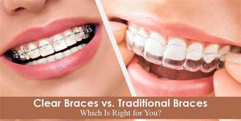 Clear Braces vs. Traditional Braces: Which Is Right for You?